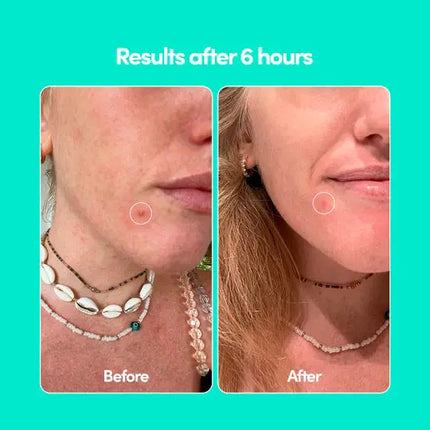 Merci Handy Pimple Patches